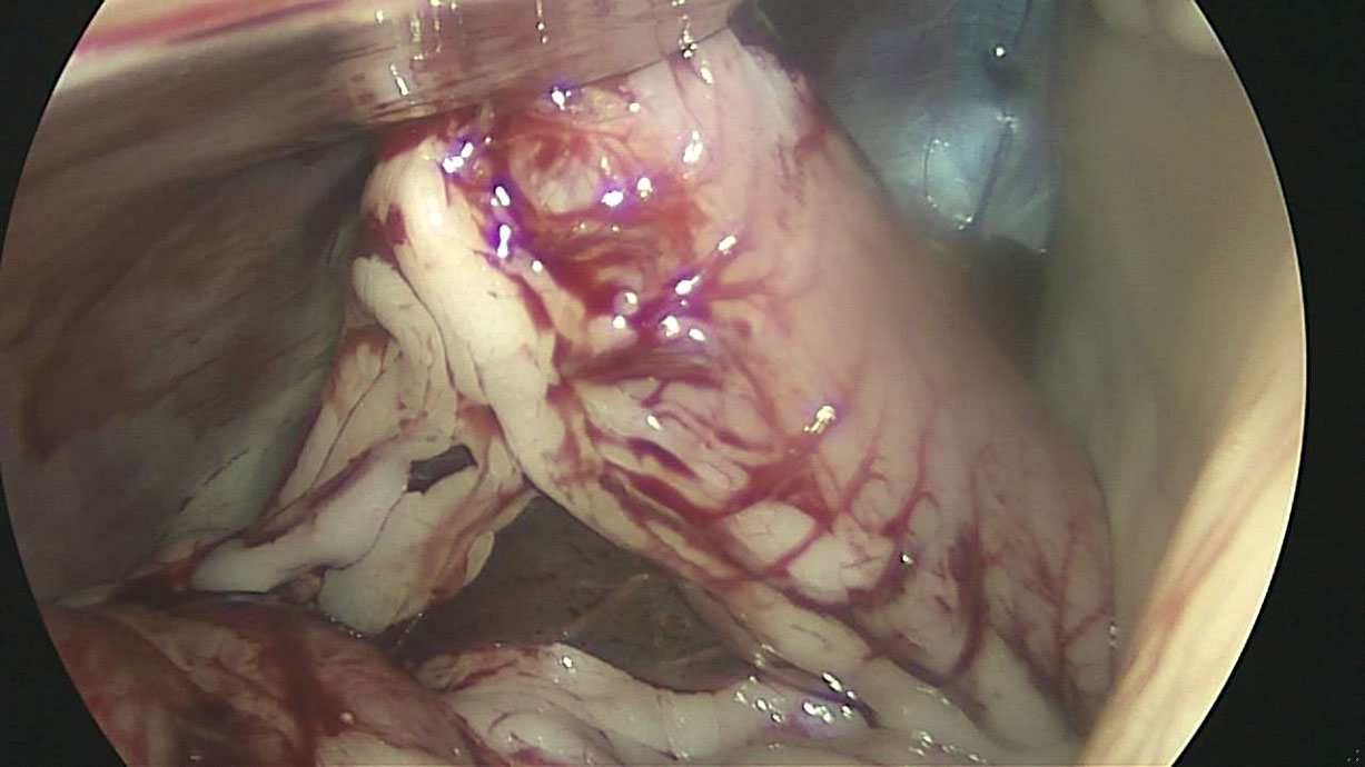 Photo of stomach after Gastropexy