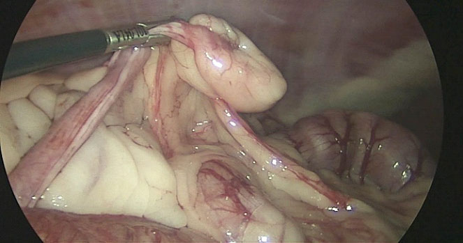 Left photo shows ovary and uterus.