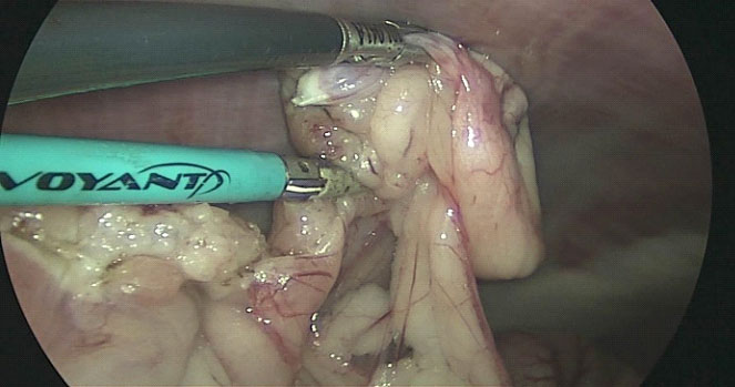 Right photo shows ovary being transected.